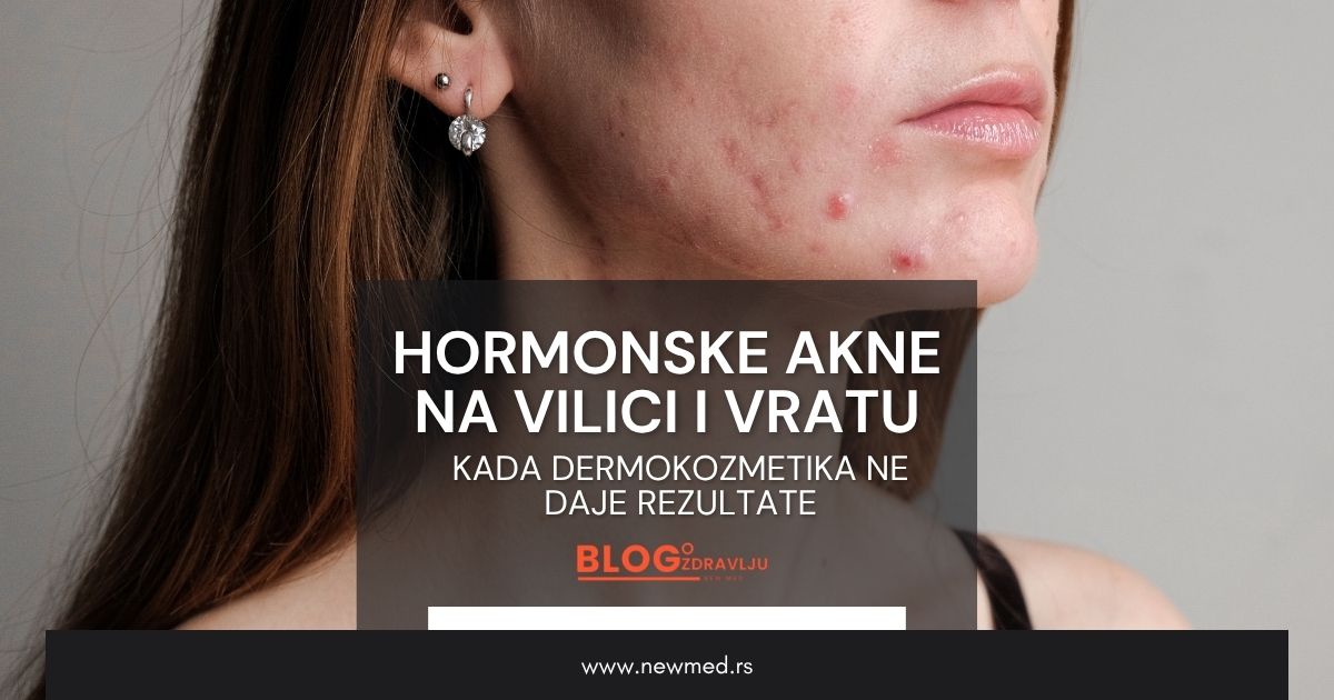 Hormonske akne